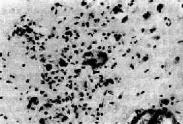 AIDS�Ǽ�������